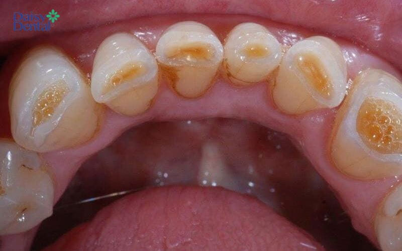 Miếng trám trên răng đã lấy tủy sẽ bị bong tróc theo thời gian