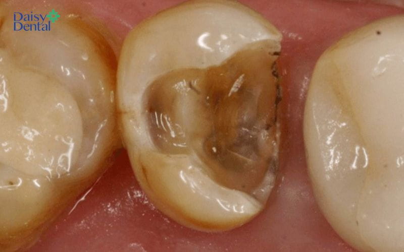 Miếng trám răng bị bong ra, khiến vi khuẩn xâm nhập và gây sâu răng