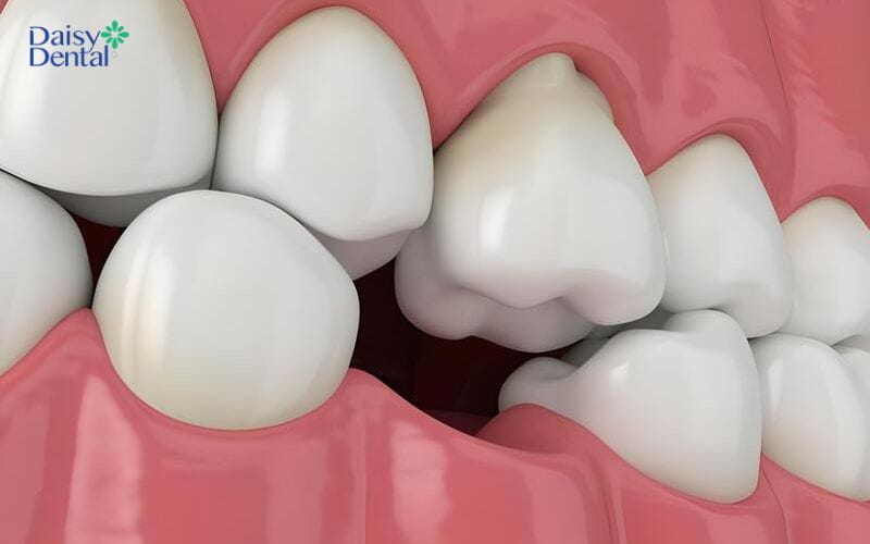 Nguy cơ mất răng sau khi lấy tủy khá cao