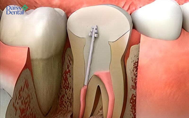 Tái tạo thân răng sau khi điều trị tủy là việc làm rất quan trọng
