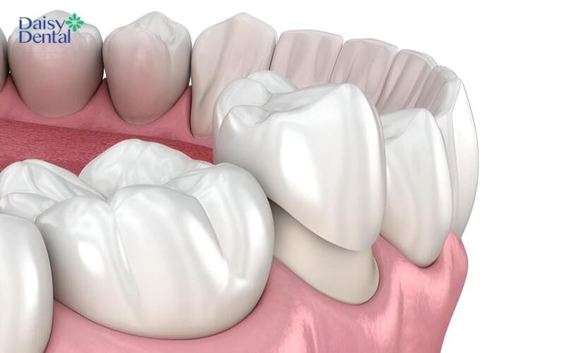 Bọc răng sứ là cách chăm sóc răng sau khi lấy tủy tốt nhất