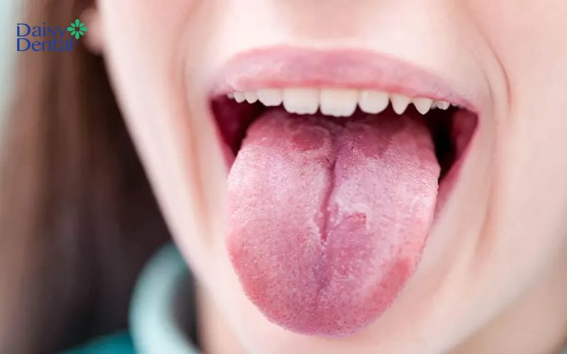 Biểu hiện của bệnh viêm lưỡi bản đồ