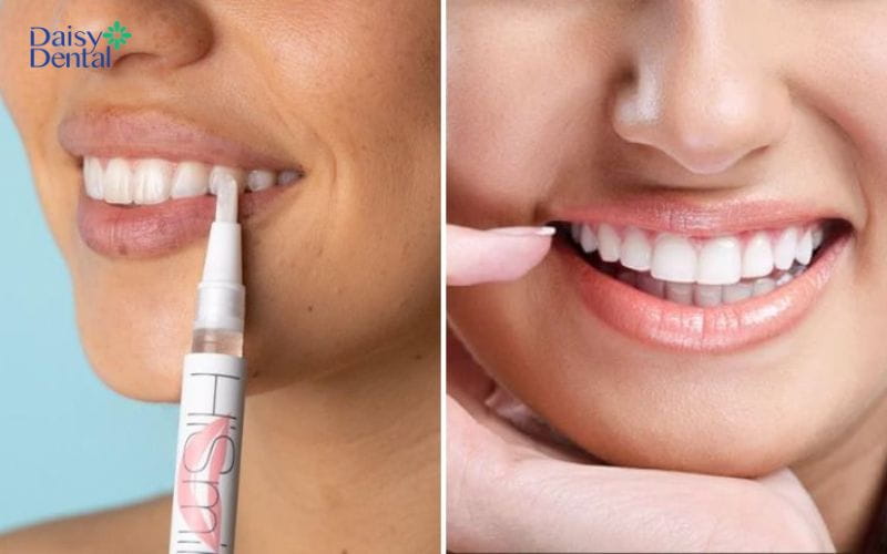 Bút tẩy trắng răng chứa chất làm trắng chuyên dụng với nồng độ vừa phải