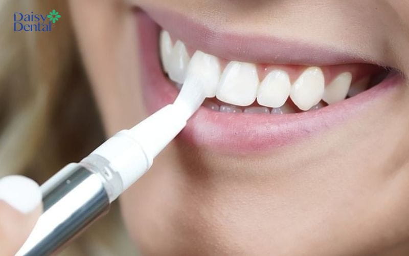 Bút tẩy trắng răng có khả năng loại bỏ các vết ố vàng trên răng