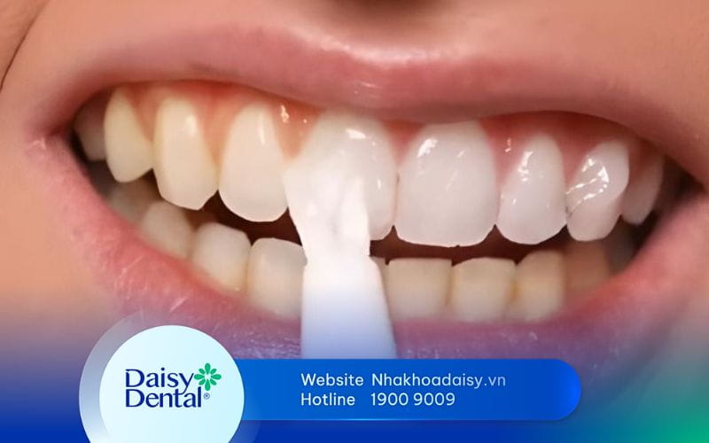 cách sử dụng bút tẩy trắng răng