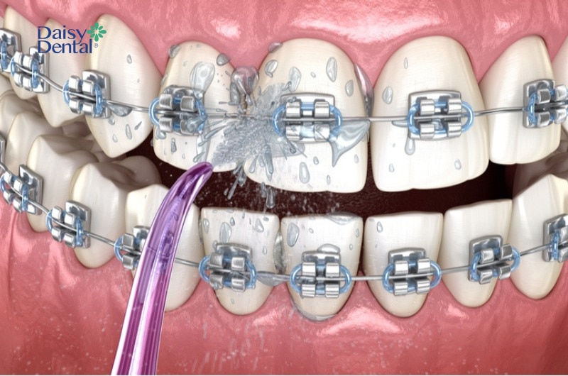 Thiết bị này có khả năng làm sạch sâu ở kẽ răng và mắc cài