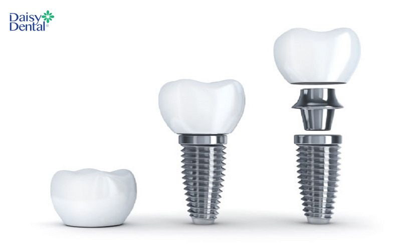 Mão răng sứ là bộ phận trên cùng của cấu tạo răng Implant