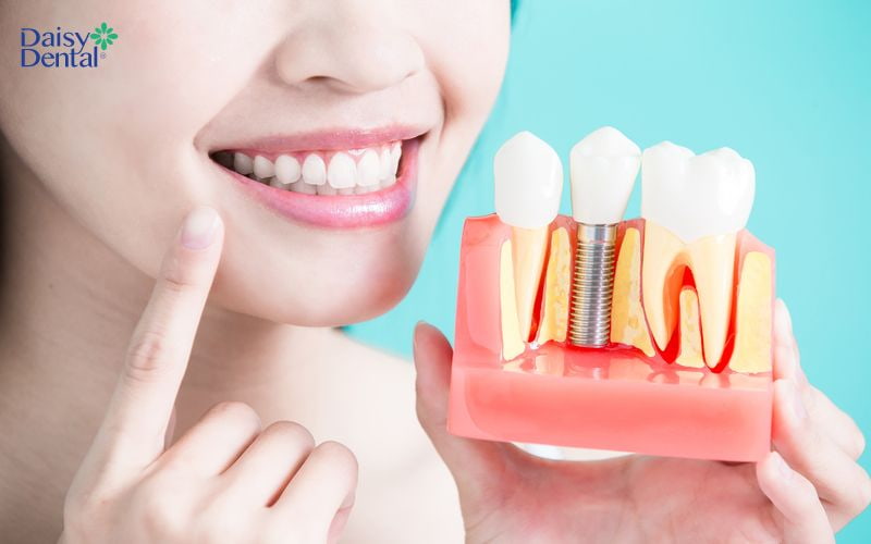 Trụ Implant được chọn phải có khả năng tích hợp tốt với xương hàm