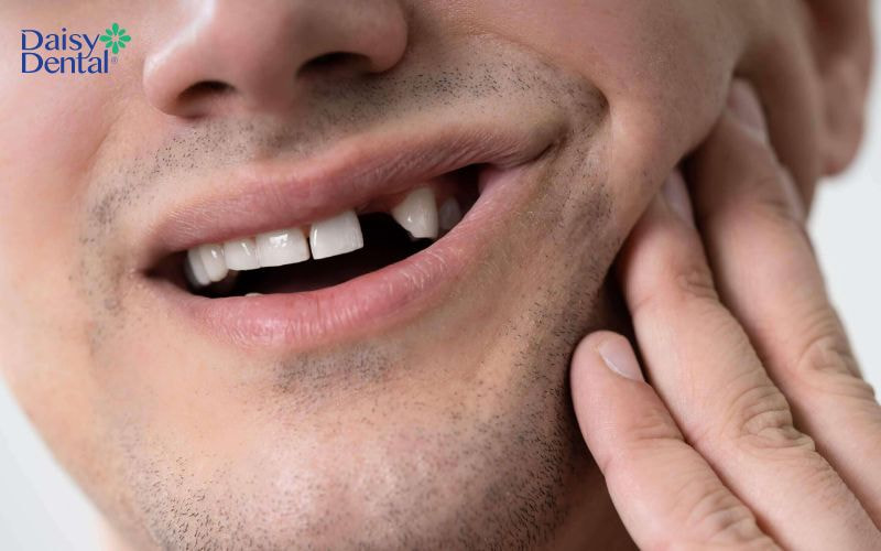 Gãy răng không chỉ làm giảm tính thẩm mỹ mà còn ảnh hưởng đến khả năng ăn nhai