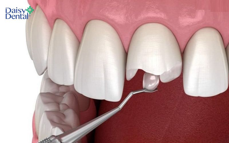 Trám răng là một trong những phương pháp phục hình răng bị gãy hiệu quả nhất