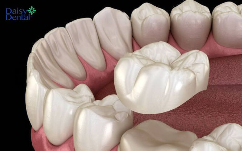 Bọc răng sứ được áp dụng trong trường hợp răng bị gãy nhiều, không thể hàn trám