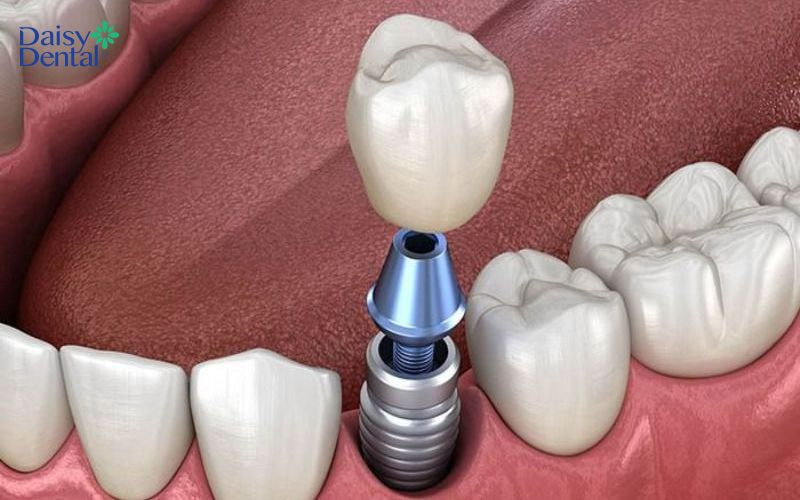 Trồng Implant cho khả năng ăn nhai chắc chắn, tính thẩm mỹ cao