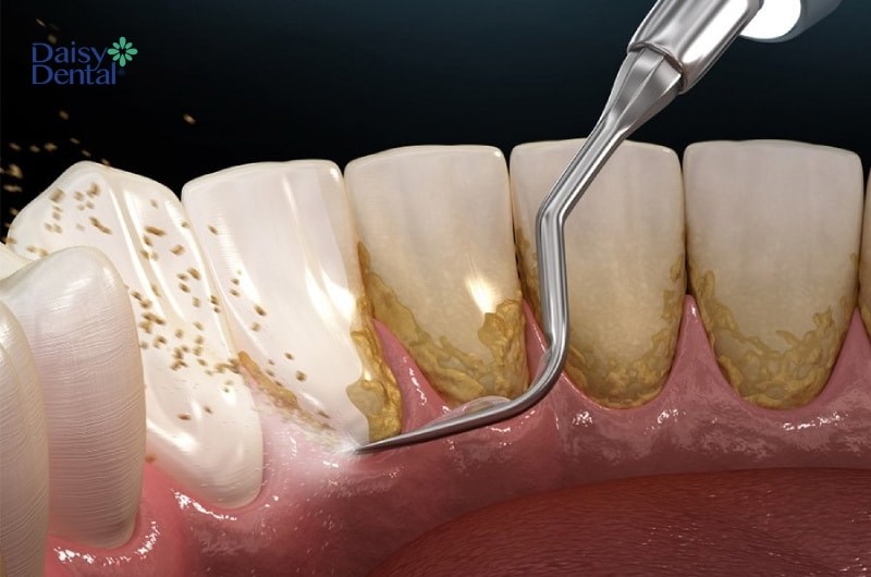 Khi thực hiện lấy cao răng tại nhà có thể gây hại cho phần nướu