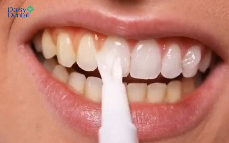 Gel tẩy trắng giúp đẩy lùi các sắc tố gây ố vàng trên răng và giúp răng trắng sáng