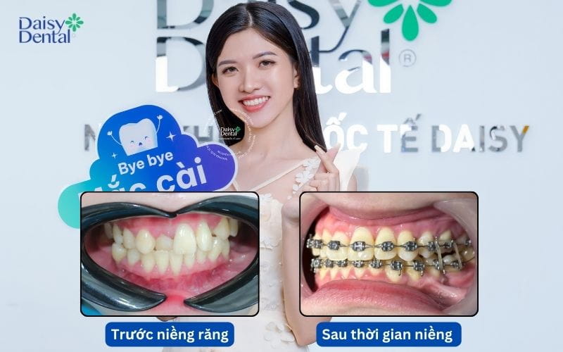Khách hàng Phương Quỳnh và hình ảnh trước và sau khi niềng răng