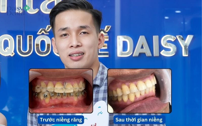 Khách hàng Bắc cảm thấy tự tin hơn sau khi niềng răng
