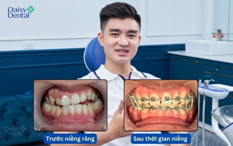 Bạn Huy cảm thấy tự tin hơn sau khi niềng răng
