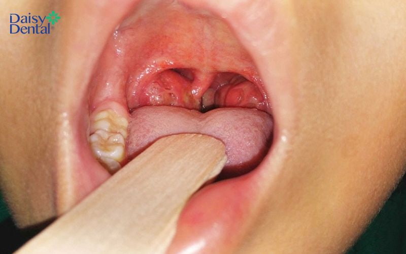 Vùng họng, amidan sưng to khiến người bệnh đau rát khó chịu