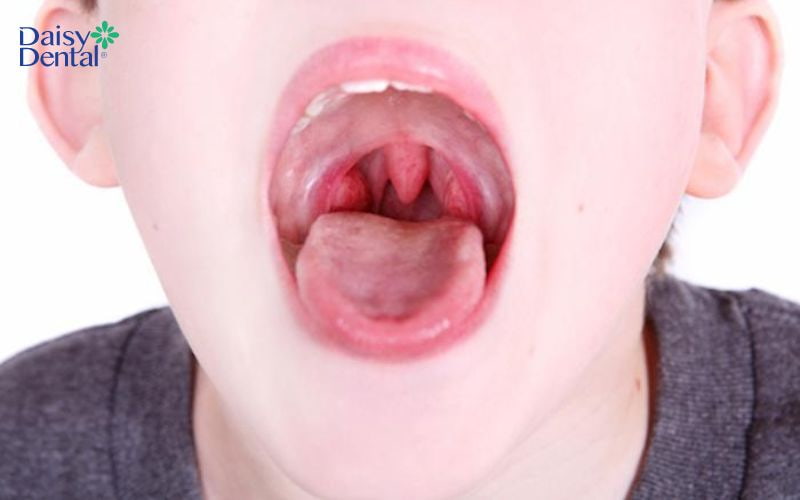 Bố mẹ cần đưa trẻ đi khám và điều trị viêm họng càng sớm càng tốt