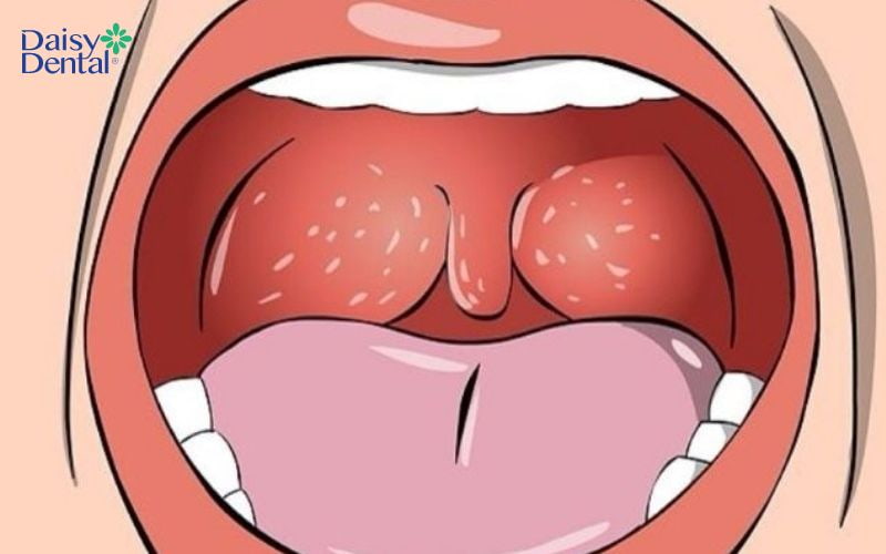 Tình trạng họng và amidan sưng to, hốc mủ nếu không được can thiệp kịp thời sẽ rất nguy hiểm