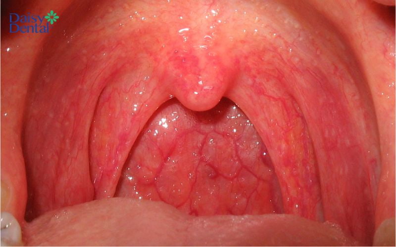 Bạn có thể nhận biết bệnh bằng cách quan sát màu sắc vòm họng