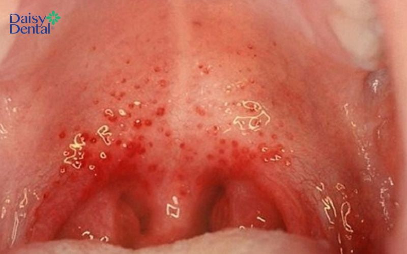 Tình trạng viêm họng xuất tiết