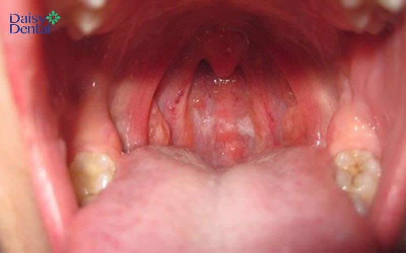 Vùng họng bị sưng và đỏ hơn so với bình thường