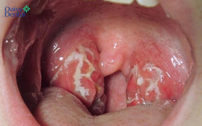 Tình trạng vùng họng sưng to, hốc mủ