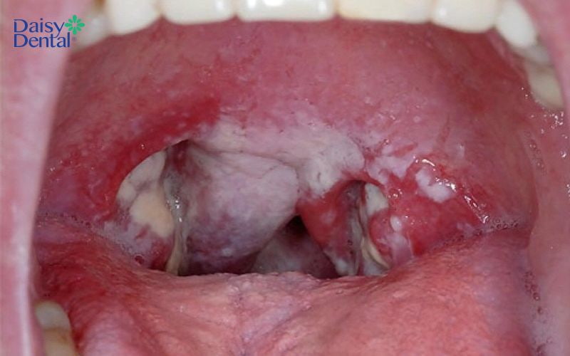 Nếu gặp phải tình trạng viêm họng trắng, bạn nên điều trị sớm