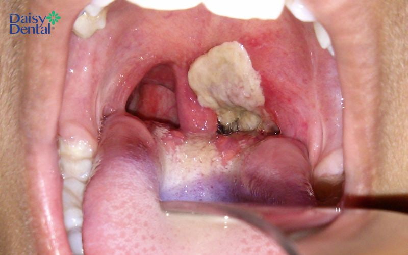 Tình trạng viêm họng giả mạc
