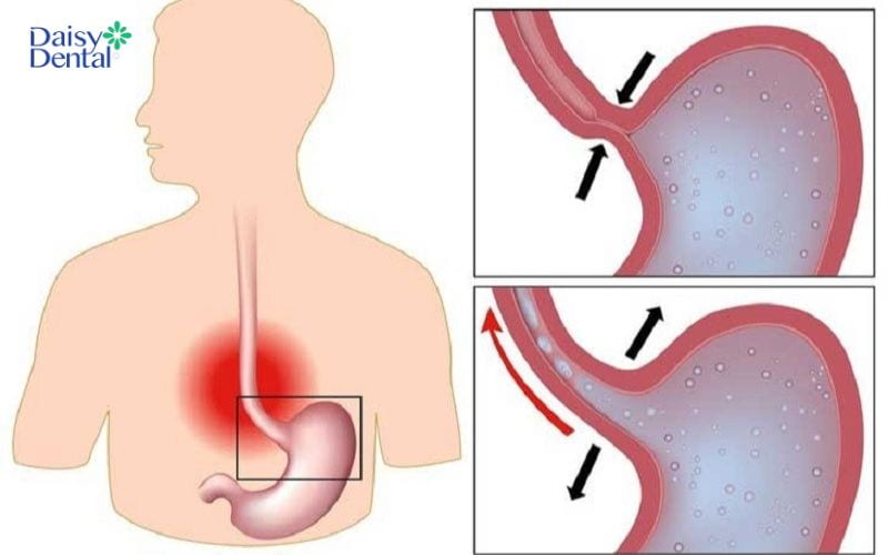 Van dạ dày mở quá mức sẽ dẫn đến tình trạng hở van dạ dày