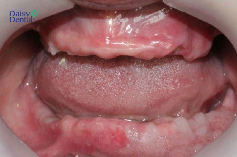 Những người bị mất răng toàn hàm cần trồng răng Implant All on 4 để khôi phục khả năng ăn nhai.