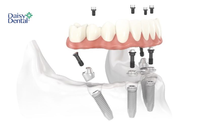 Chi phí thực hiện kỹ thuật này thường bao gồm trụ Implant, khớp nối và răng sứ.