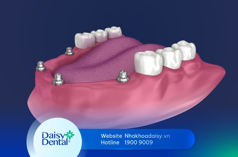 Implant all on 4