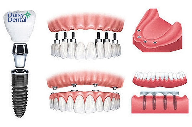 Phương pháp All On 6 mang lại hiệu quả kinh tế cao