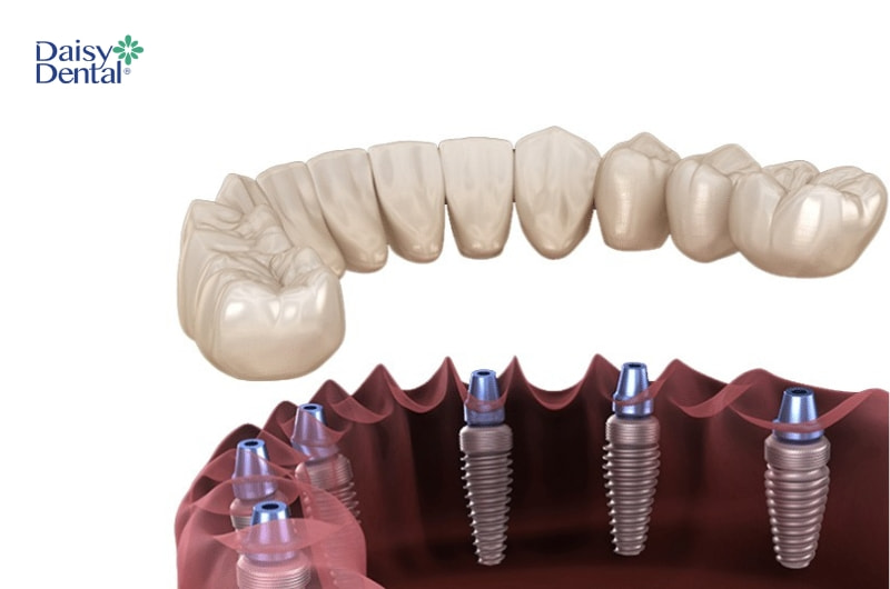 Kỹ thuật cải thiện thẩm mỹ răng miệng hiệu quả sau khi thực hiện