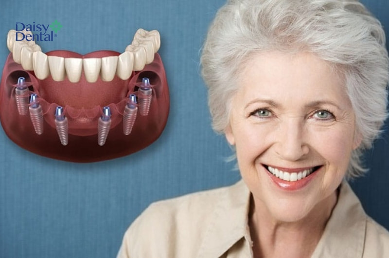 Độ bền lâu dài là ưu điểm của răng cấy ghép bằng kỹ thuật All On 6