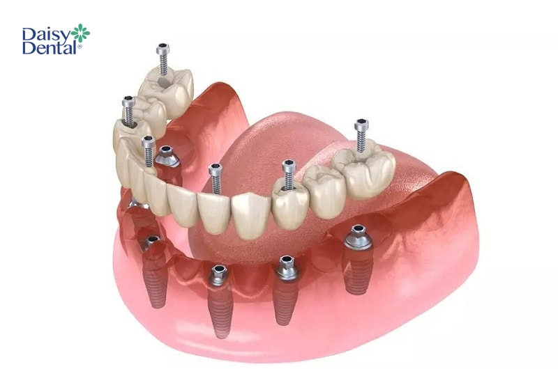 Phục hình răng trên Implant để hoàn tất quy trình