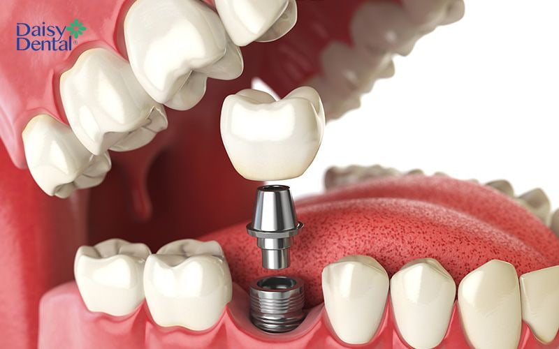 Trụ Implant có tính tương thích sinh học cao, không xảy ra trường hợp đào thải