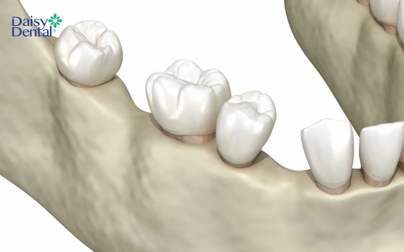 Cấy ghép Implant sớm sẽ giúp ngăn tình trạng tiêu xương hàm do mất răng