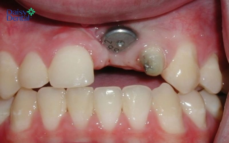 Trồng răng Implant tại cơ sở giá rẻ kém chất lượng sẽ có nguy cơ bị đào thải nhanh