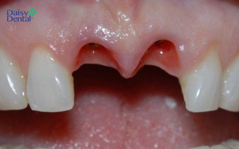 Tình trạng mất 2 răng cửa liên tiếp