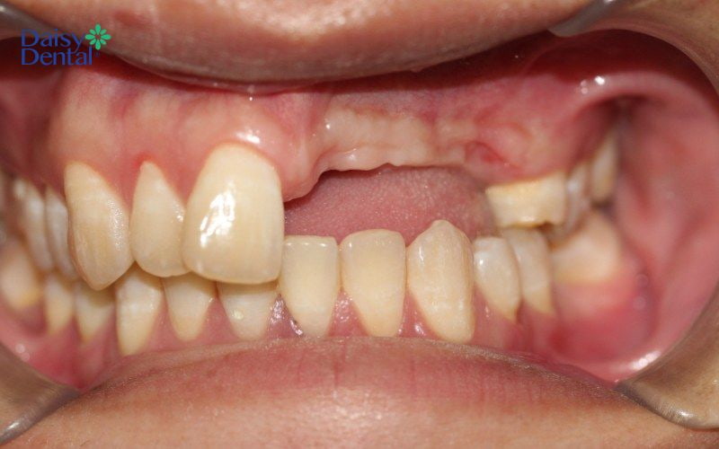 Mất răng cửa làm giảm tính thẩm mỹ của khuôn mặt