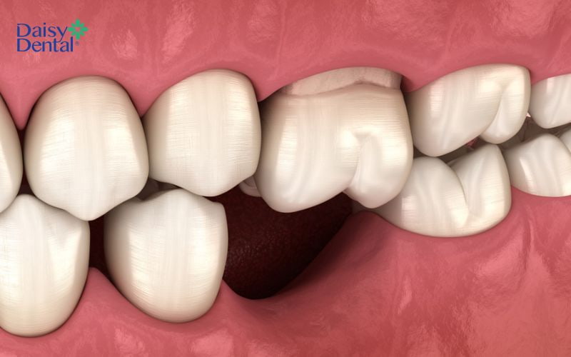 Các răng xung quanh có xu hướng xô lệch về vị trí răng bị mất