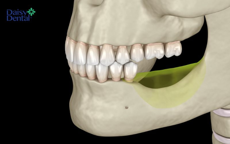 Nếu không khắc phục sớm, mất răng có thể dẫn đến tiêu xương hàm