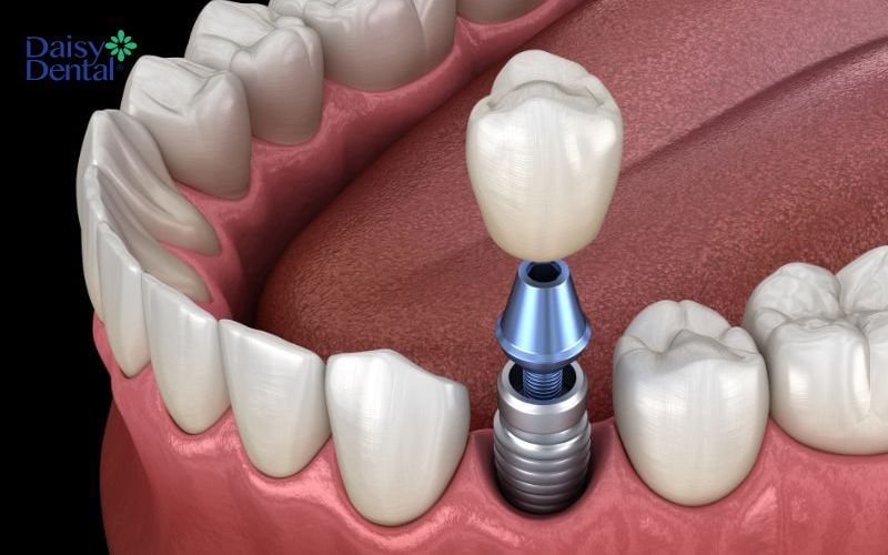 Cấy ghép Implant là phương pháp phục hình răng được nhiều người ưa chuộng nhất hiện nay