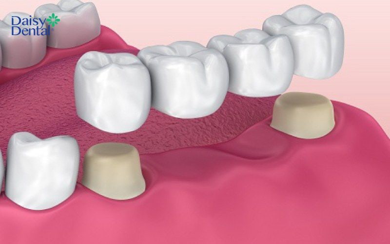 Cầu răng sứ cũng là một kỹ thuật phục hình răng phổ biến trong nha khoa