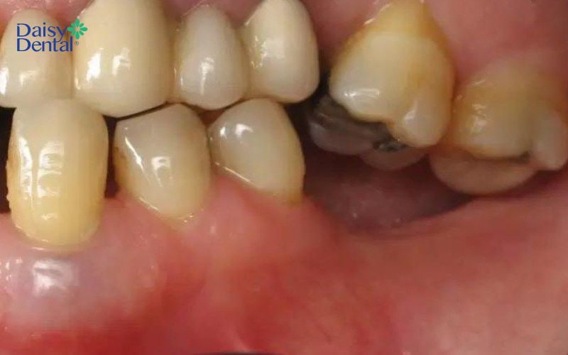Mất các răng cối lớn bên trong cung hàm