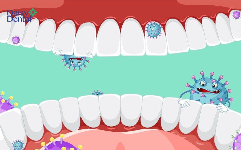 Vệ sinh răng miệng không hiệu quả là nguyên nhân hàng đầu gây mất 2 răng liền kề