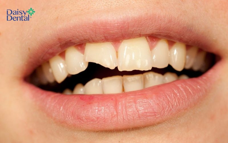 Vi khuẩn có thể tấn công phá hủy cấu trúc răng khi răng bị gãy